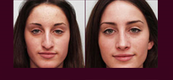 Rhinoplasty Los Angeles