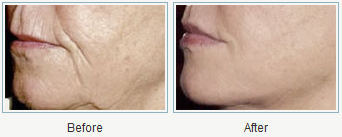 sculptra-los-angels sculptra-los-angels
