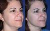 ulthera before and after