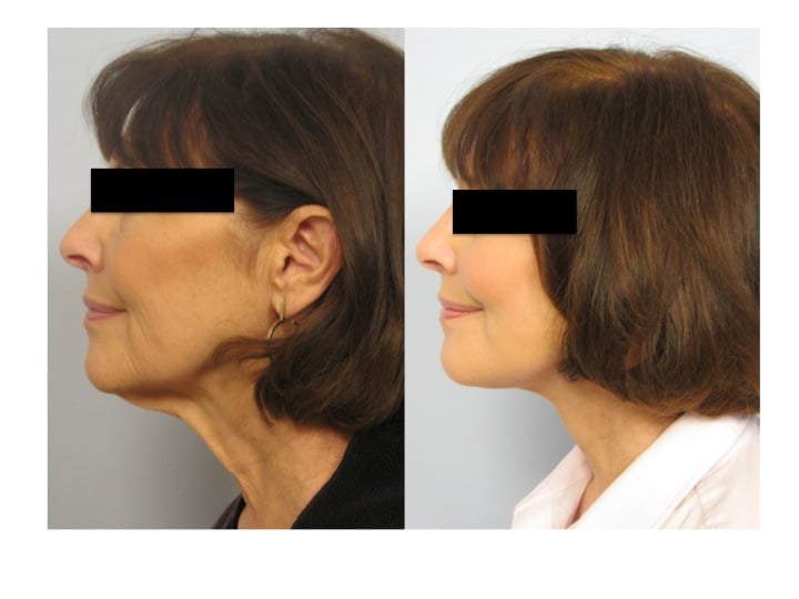 Ultherapy (Ulthera) 2012 Update: “Doc, Will Ultherapy Work, or Do I Need a Facelift?”