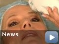 Ulthera Featured on TODAY Show, Kathie Lee Gifford Treated