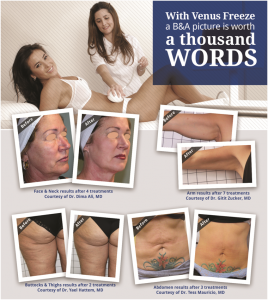 Venus Freeze Skin Tightening Available at Persky Sunder Facial Plastic Surgery Venus Freeze Skin Tightening Available at Persky Sunder Facial Plastic Surgery
