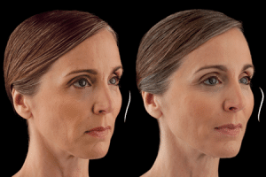 Voluma Frequently Asked Questions (FAQs) at Persky Sunder Facial Plastic Surgery in Los Angeles, Beverly Hills, and “The Valley” Voluma Frequently Asked Questions (FAQs) at Persky Sunder Facial Plastic Surgery in Los Angeles, Beverly Hills, and “The Valley”