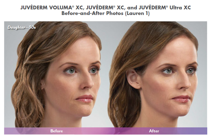 juvederm before after