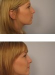 What You Need to Know About Rhinoplasty at Persky Sunder Plastic Surgery