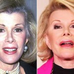 JoanRivers before and after