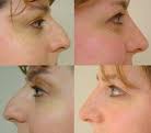 The Non-Surgical Nose Job (Rhinoplasty) or the “Liquid” Rhinoplasty FAQs