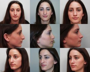 Rhinoplasty Pre-Operative Computer Imaging Found to be Useful
