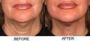 Ultherapy by Ulthera…The New “Lunchtime Face/Neck Lift”! in Beverly Hills, Los Angeles, Hollywood, Hancock Park, Brentwood, Santa Monica, Pacific Palisades, Malibu, Sherman Oaks, Studio City, Calabasas, Encino, Woodland Hills, Tarzana, Westlake, Thousand Oaks, Agoura Hills, and the San Fernando Valley