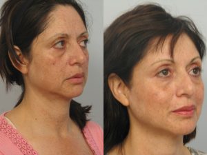 Before and After. Ulthera of Face, Neck, and Eye Brows with Restylane Under Eyes