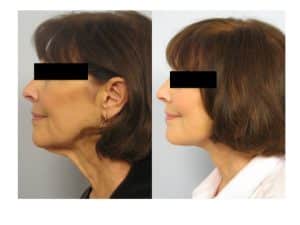 Face/Neck Lift Actual Patient Results