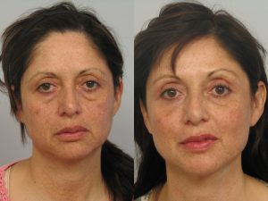 Ultherapy Before and After Results