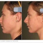 Before and After Ultherapy (Author)