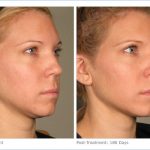 Ulthera Patient Note Improvement of Jawline