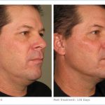 Male Ultherapy Patient After 4 Months