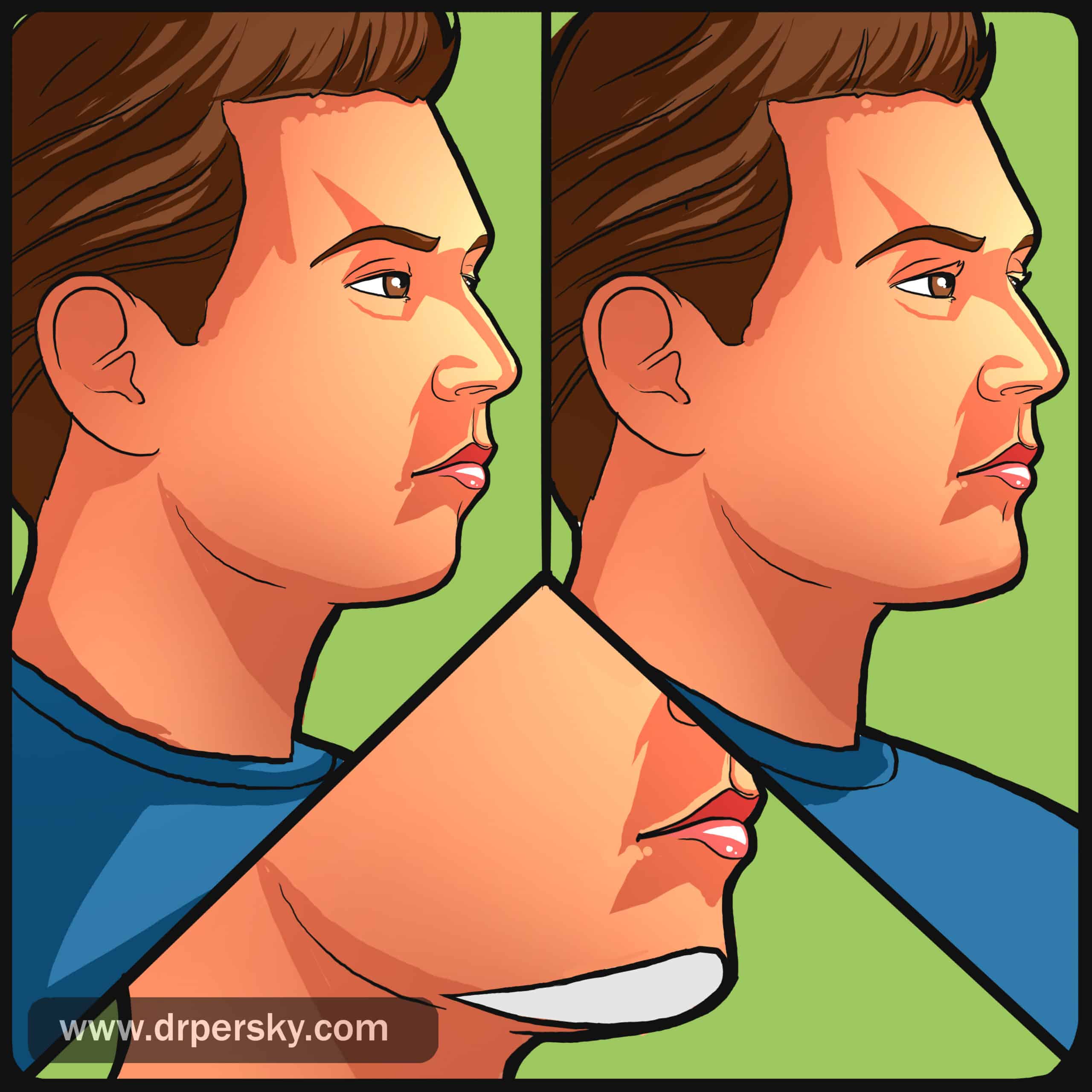 chin implants - los angeles