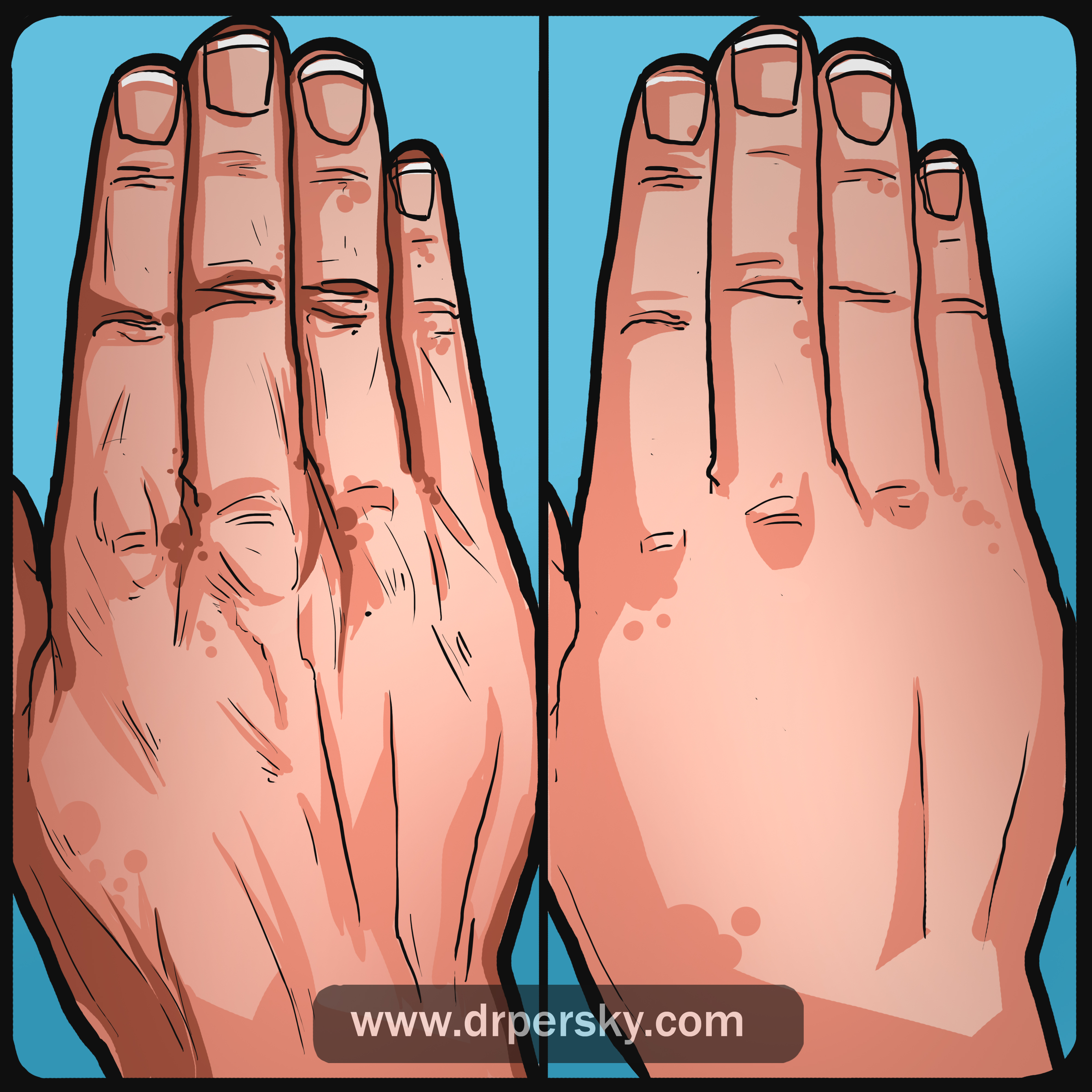 hand rejuvenation