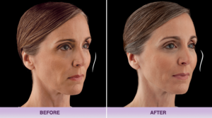 Voluma before-after-juvederm-voluma-1