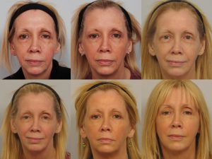 6 Months After Multiple Sculptra Sessions by Dr. Persky