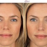 The Allergan Facial Rejuvenation Transformation at Persky Sunder Facial Plastic Surgery
