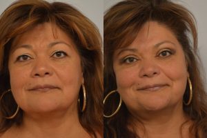 Blepharoplasty Patient 3 Before and After Picture