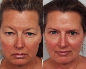 Before and after image showing the results of an eyelid lift performed in Encino, CA.