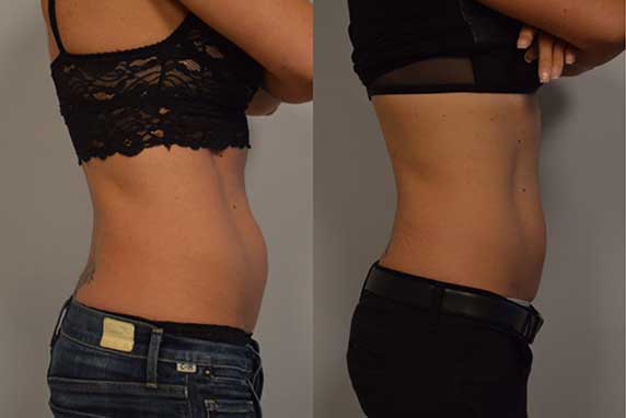 CoolSculpting Patient