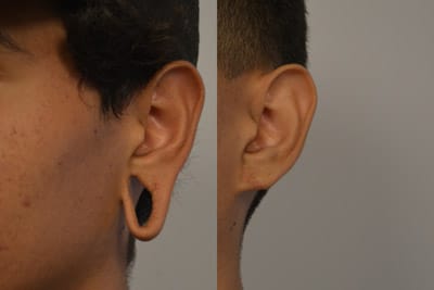 Otoplasty Patient