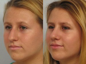Rhinoplasty Patient Before and After