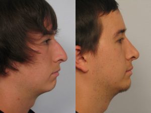 Rhinoplasty Patient before and after