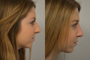 Rhinoplasty Patient