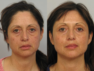 Ultherapy Patient