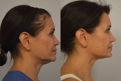 Ultherapy Patient