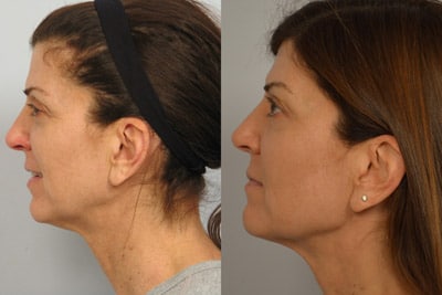 Ultherapy Patient