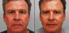 BOTOX® Cosmetic Before and After Results on Man