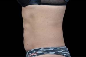 EMSCULPT® Tummy After