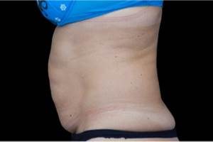 EMSCULPT® Tummy Before