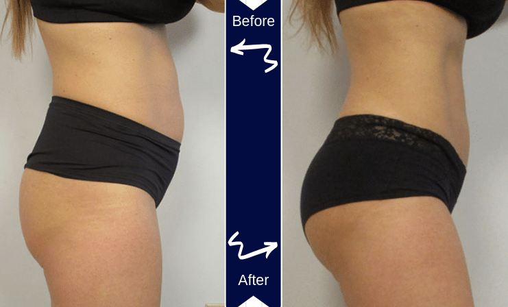 Before and after photo of woman butt and stomach