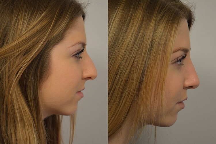 Rhinoplasty-patient