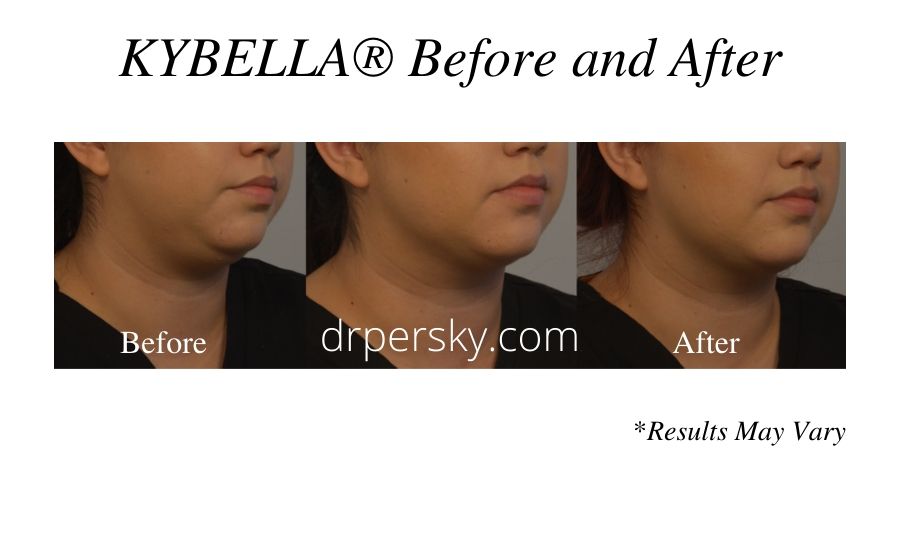 A woman before and after a KYBELLA® treatment in San Fernando to remove excess neck fat and tighten her skin.