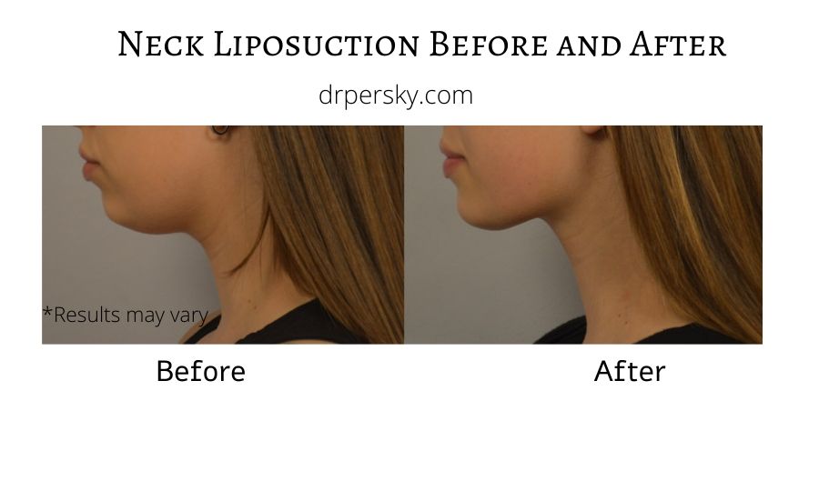 A woman before and after a liposuction treatment in Calabasas on her neck to tighten the skin and remove vertical banding.