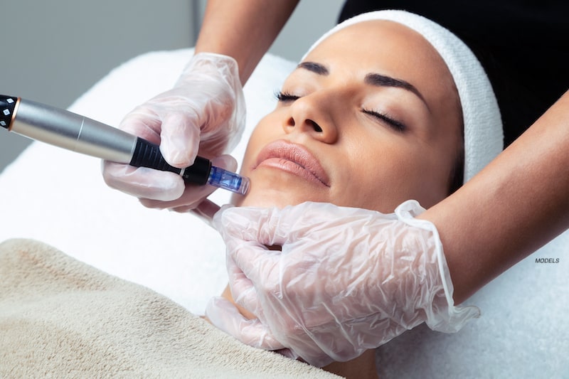 Woman getting a microneedling treatment