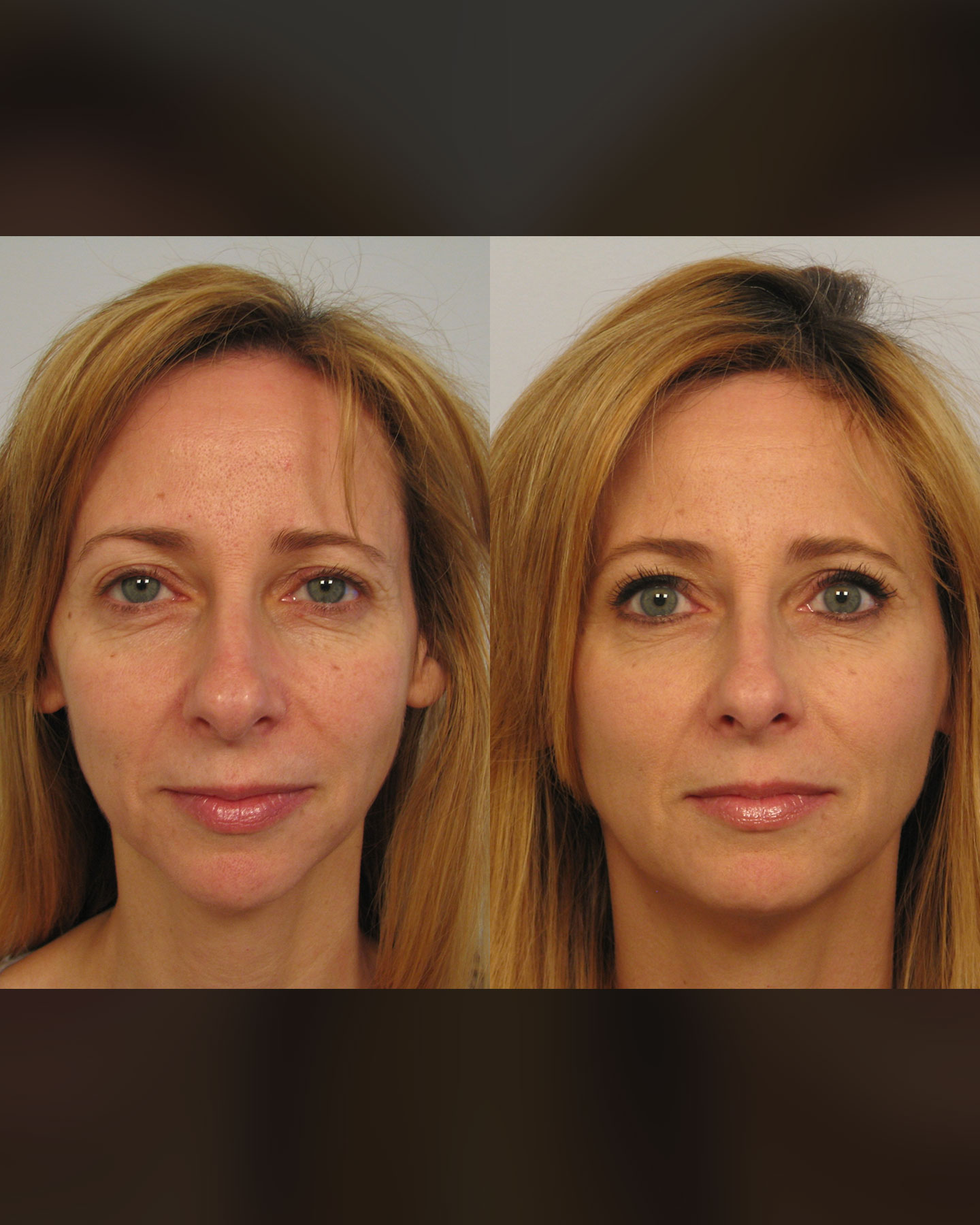 before and after sculptra
